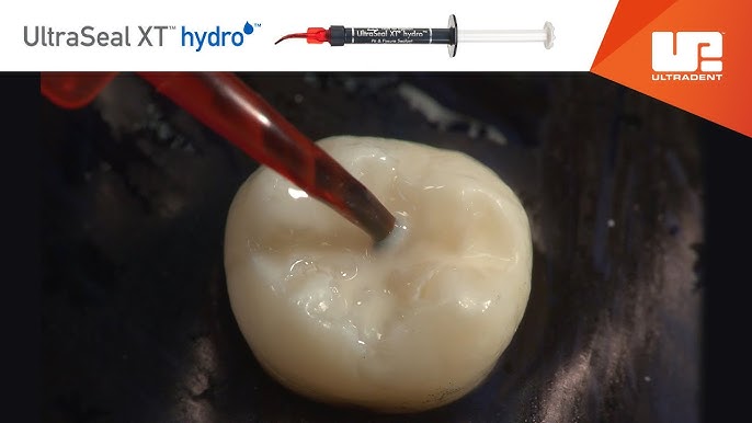 Beneficios de selladores dentales