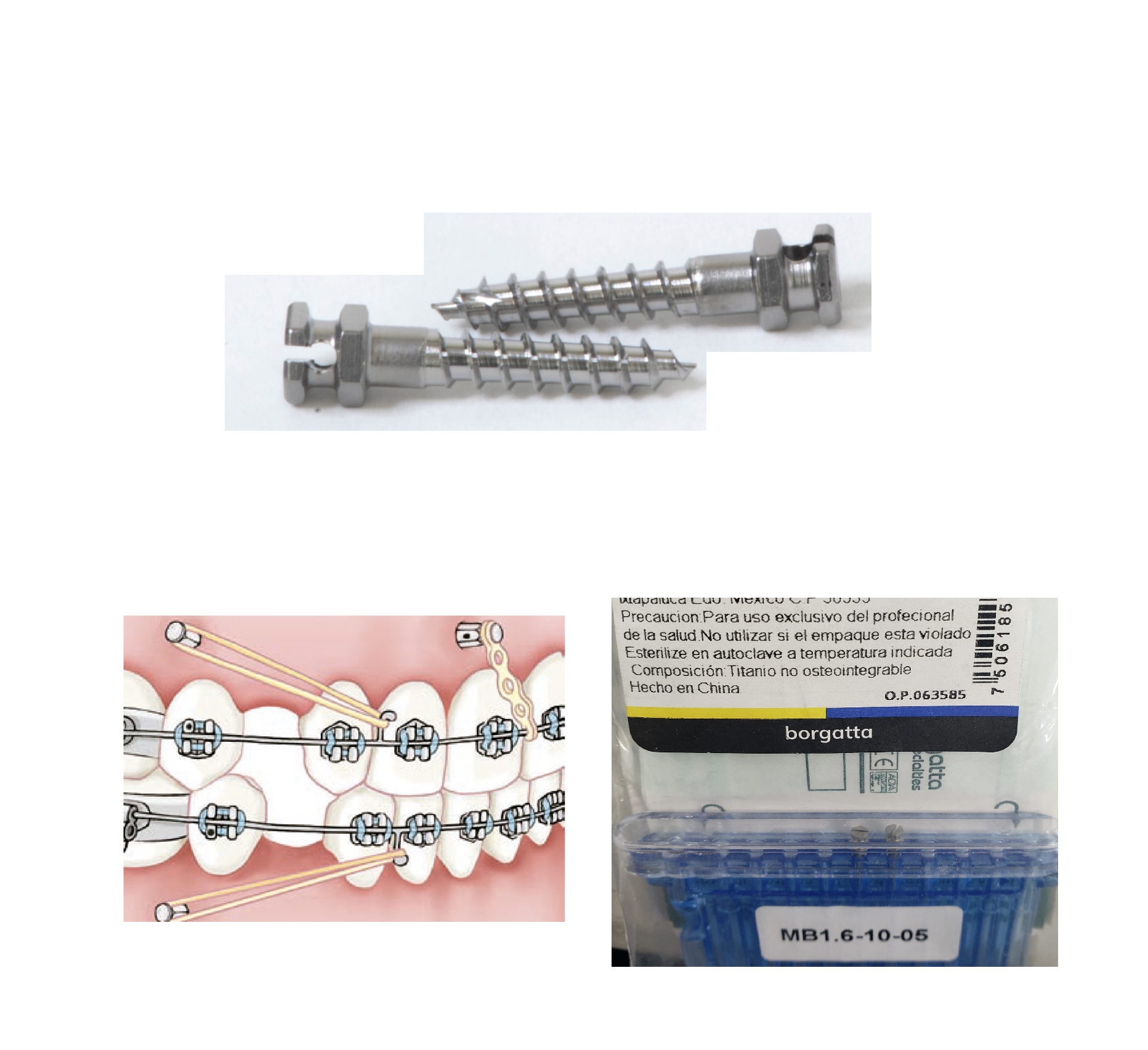 Micro Implantes Dentales Ortodoncia Borgatta Elite Ortho