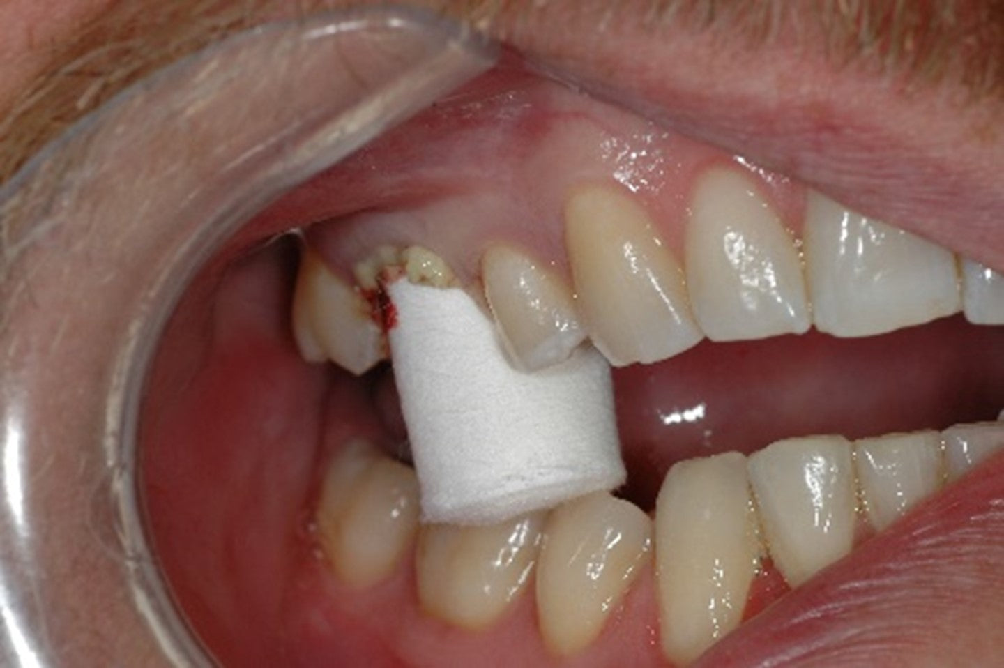 Tienda DDC - CIRUGIA - Retraction Caps - retraccion gingival dental 60pz | TiendaDDC.com