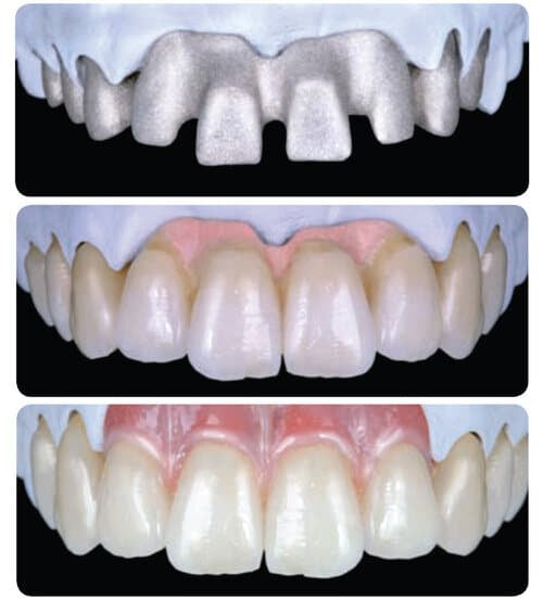 Kit resina Parafil Gingiva para encia 8 pz