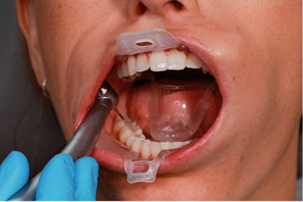 Umbrella Retractor de lengua labios y mejillas