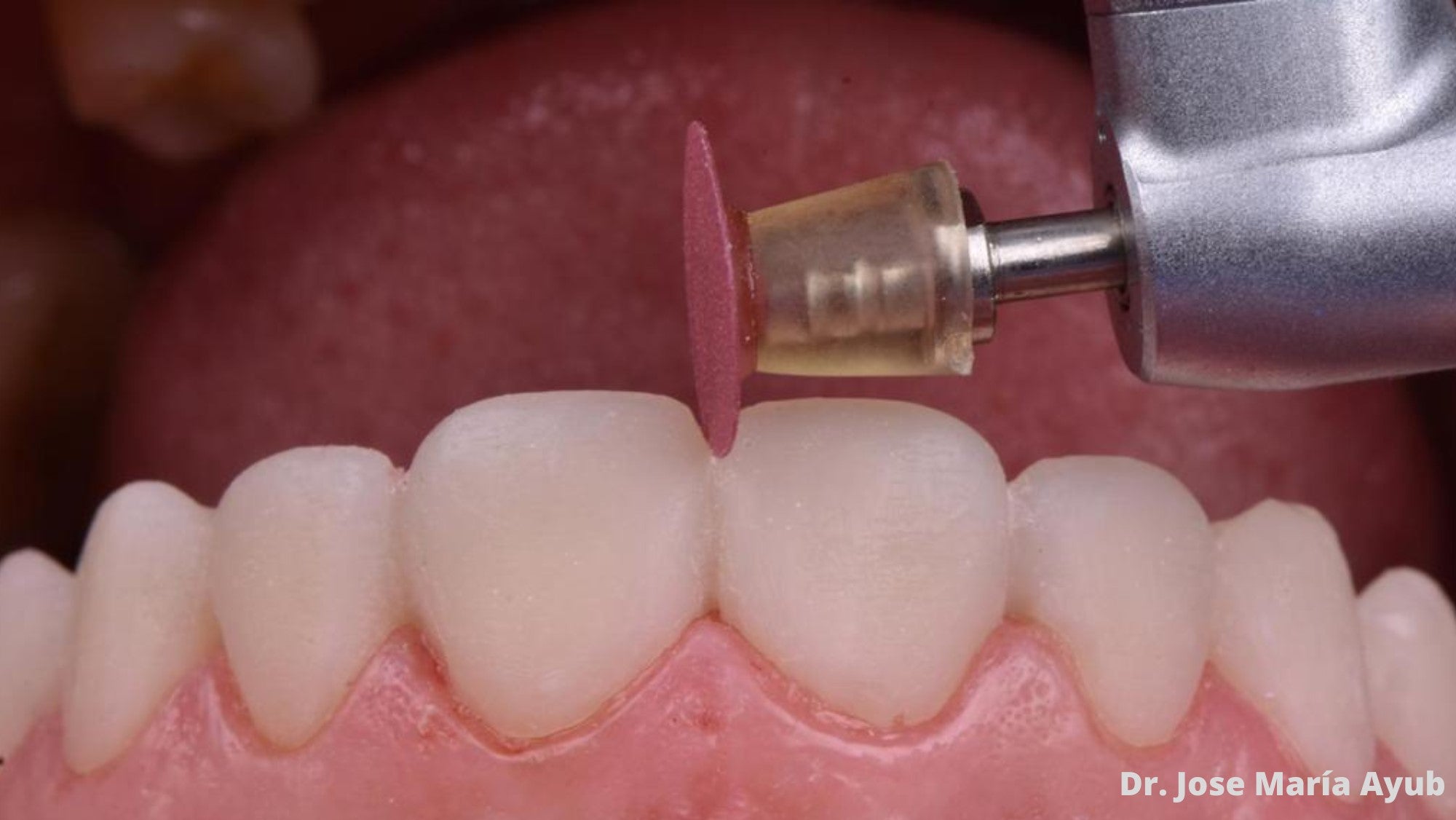 7897990326813 - TDV - RESINAS - Superfix Discos Pulido denta resina 8u + 1 madril Tdv Shofu | TiendaDDC.com