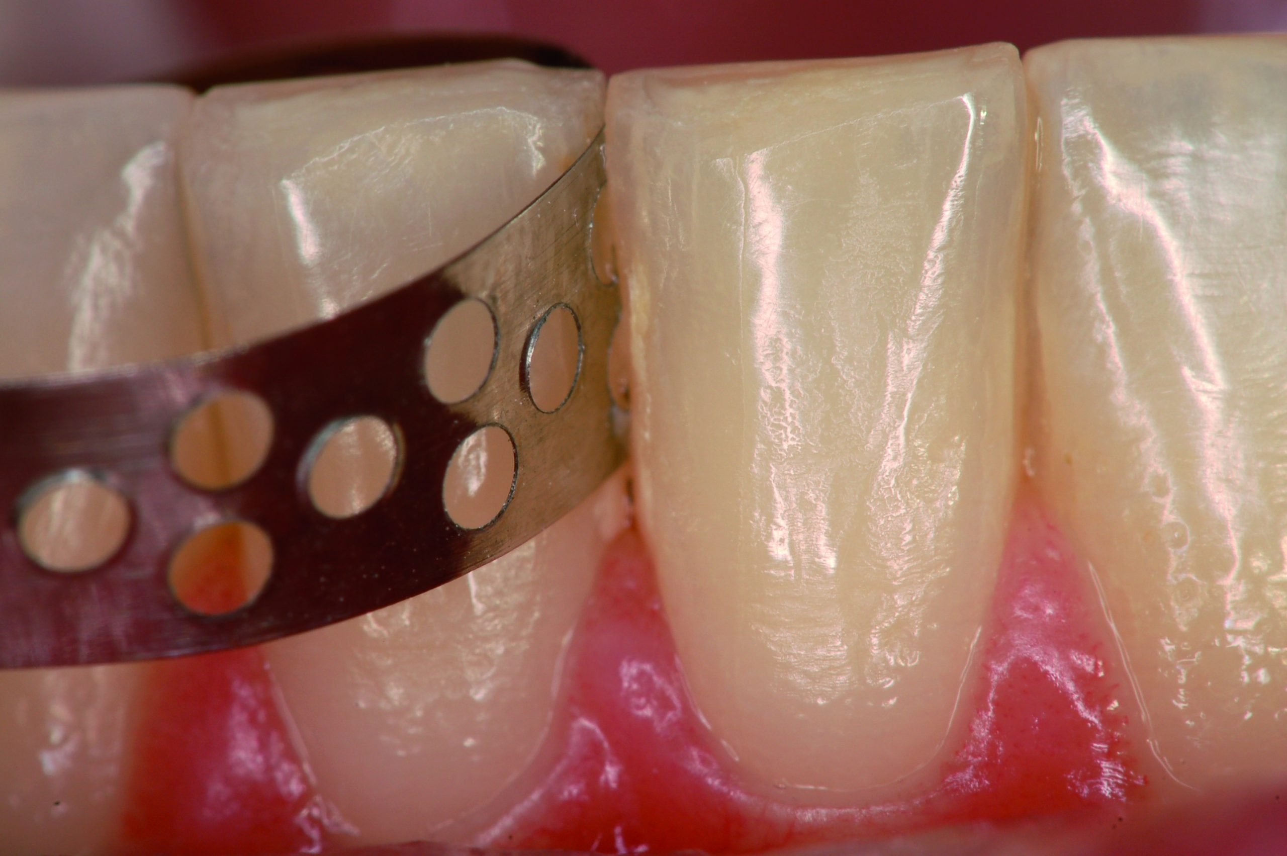 Cinta Profilactica Dental Tdv Remocion De Sarro