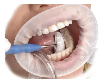Optragate Separador Para Labios Y Mejillas Ivoclar 1pz