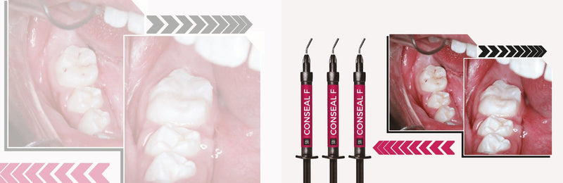 Conseal F Sellador Dental De Fosetas Y Fisuras Sdi 1gr