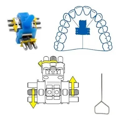 5010000497064 - Tienda DDC - ORTO - TORNILLO TRIDIMENSIONAL ANGULADO ABIERTO Superior Hyrax. | TiendaDDC.com