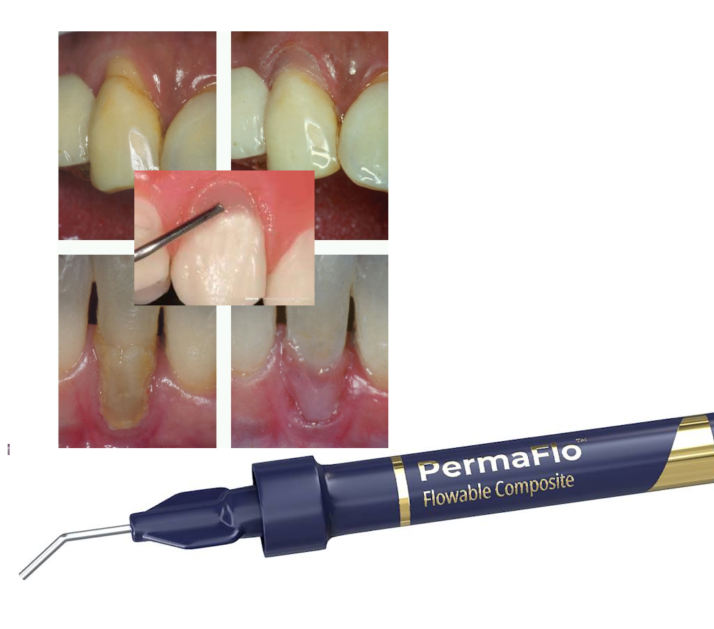 PermaFlo Pink Replicador Gingival resina fluida rosa