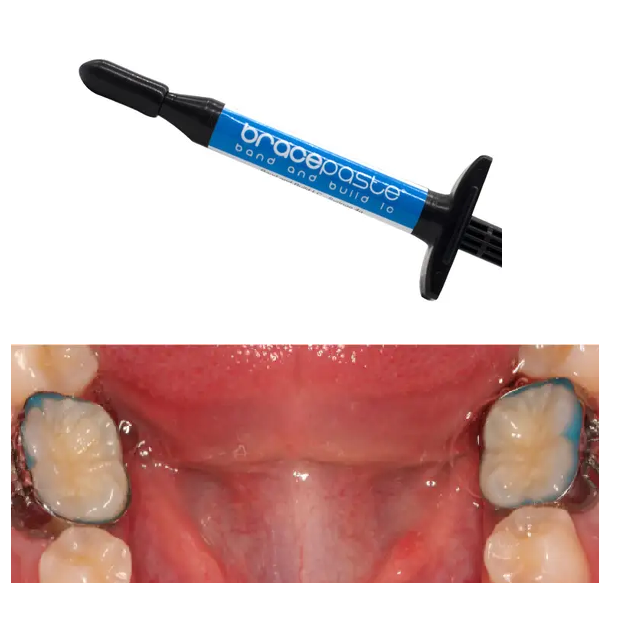 Bracepaste Resina Cementar Bandas De Ortodoncia