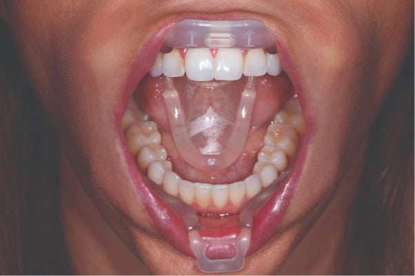 Umbrella Retractor de lengua labios y mejillas